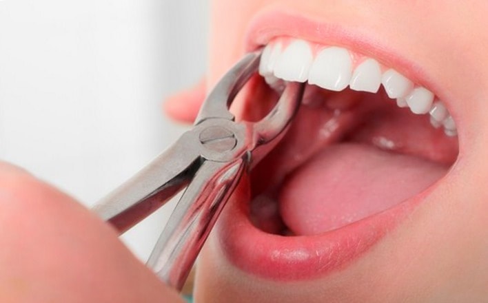 Удаление зубов в Dental Studio