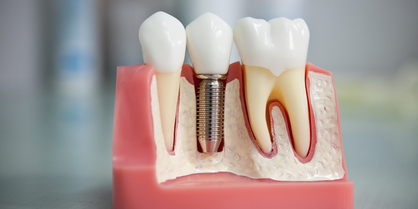 Имплантация зубов в Dental Studio
